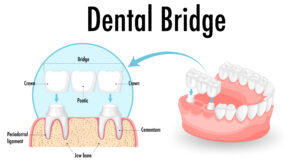 Dental Bridges in Rajajinagar