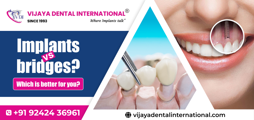 Best Dental Implants in Rajajinagar