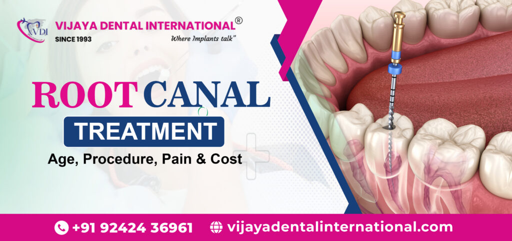 Root canal treatment in Banashankari