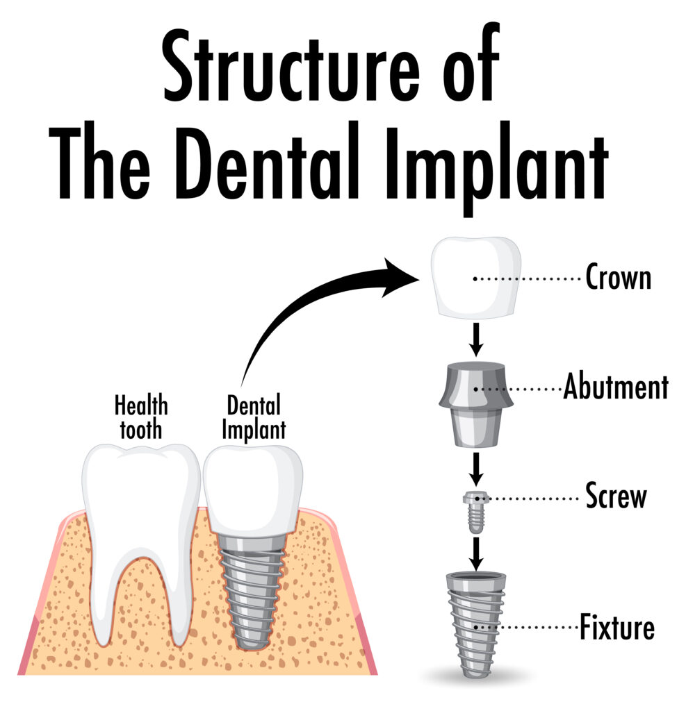 Best Dental Implants in Rajajinagar